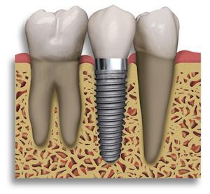 Fun Facts About Dental Implants