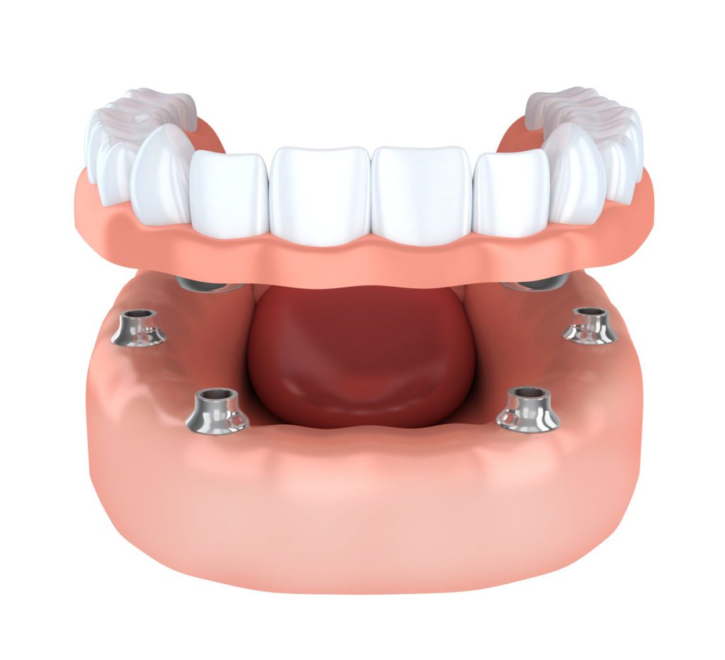 All-on-four dentures or implant-supported dentures