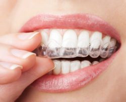 affordable Invisalign treatment in Lexington Kentucky