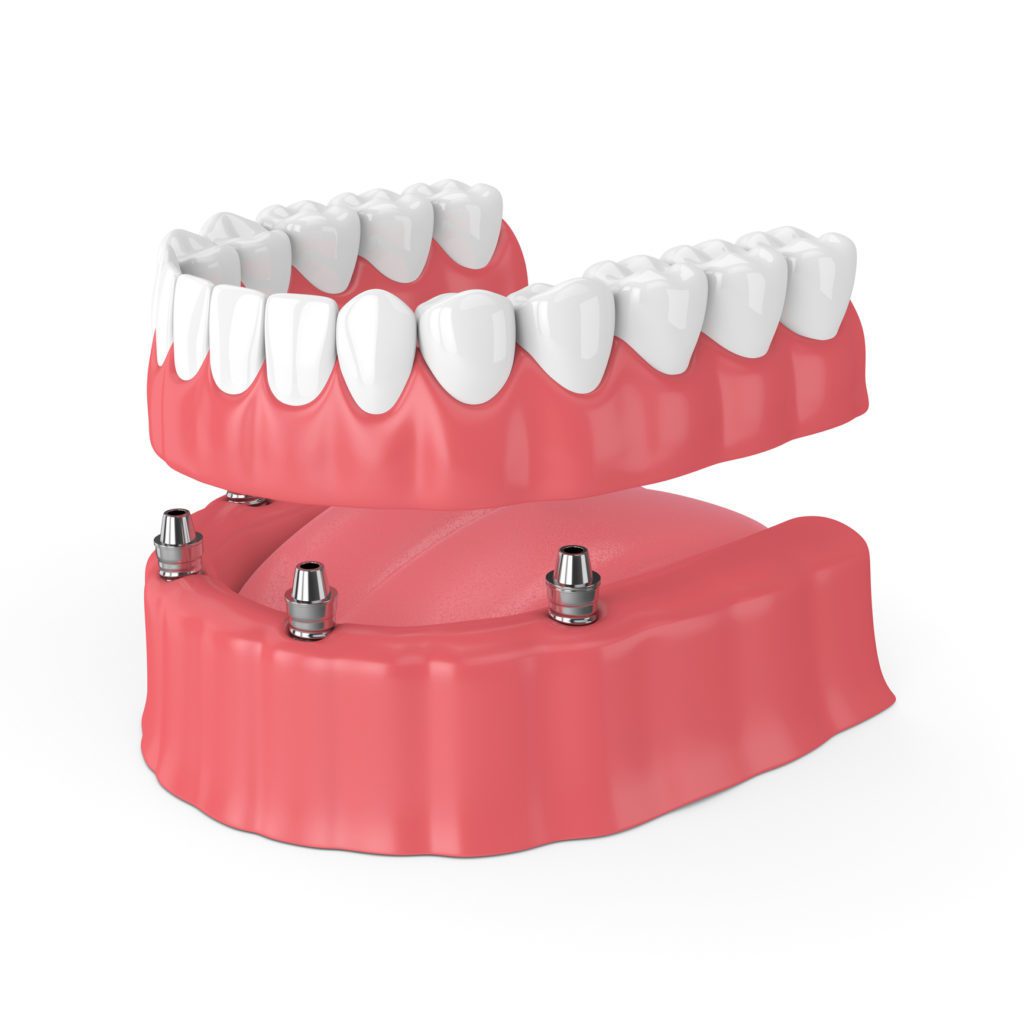 The Benefits of Implant-Secured Dentures