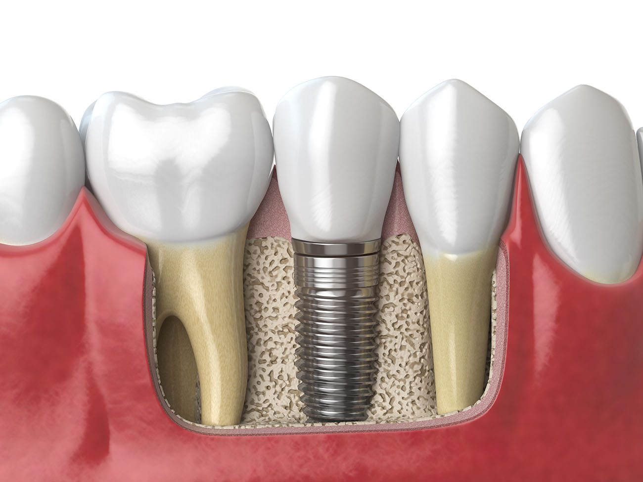 I've Been Told I Don't Have Enough Bone for Implants. Now What?