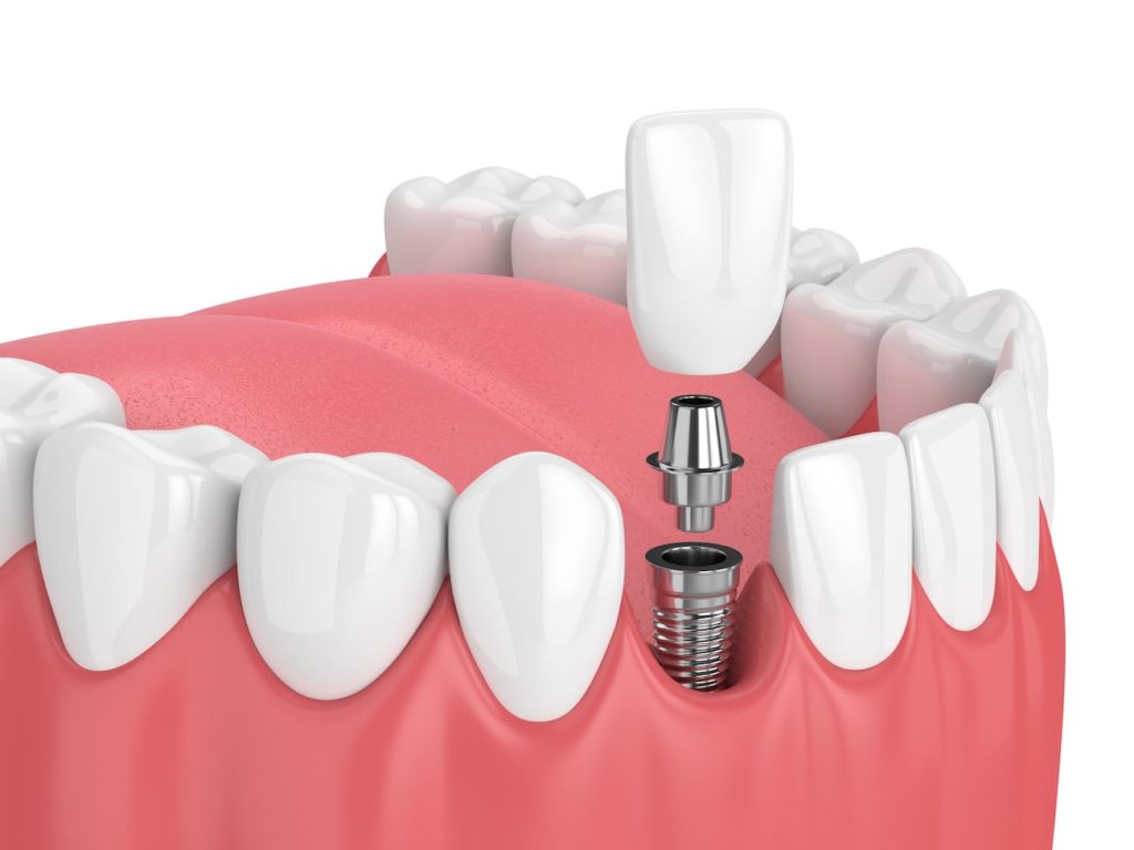 Single tooth dental implant Lexington KY