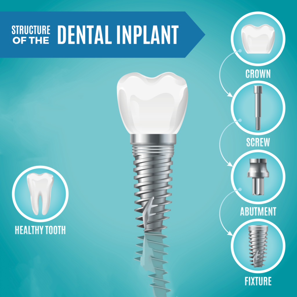 The structure of a dental implant