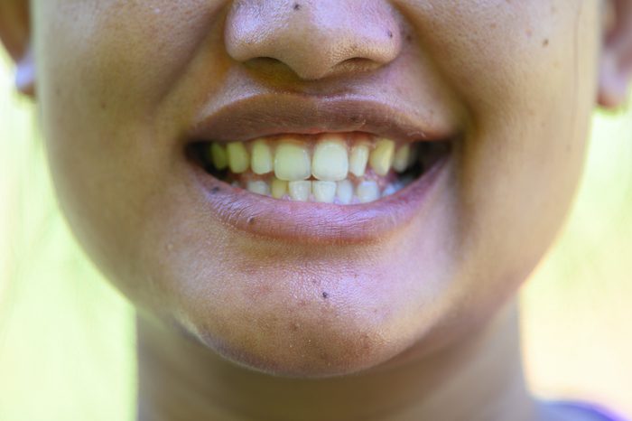 3 Options for Fixing an Unbalanced Bite