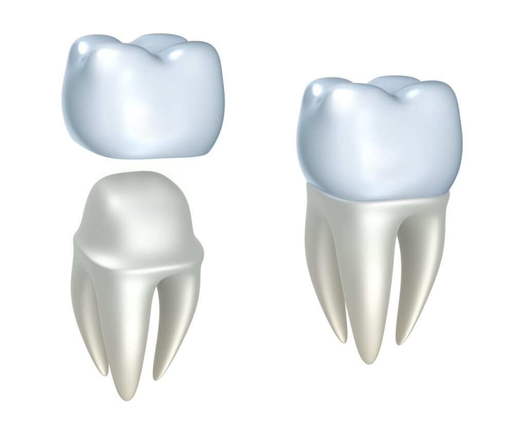 Process For Getting Dental Crowns