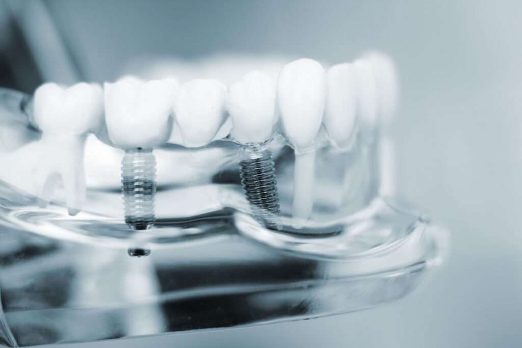 Do you Need Pretreatment for Dental Implants?