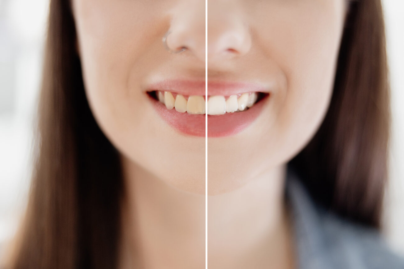 Whitening Didn't Work? Here's What It Can and Can't Fix