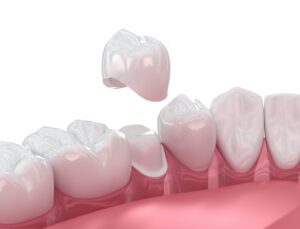 A dental crown can ease patient anxiety and ensure a smooth treatment