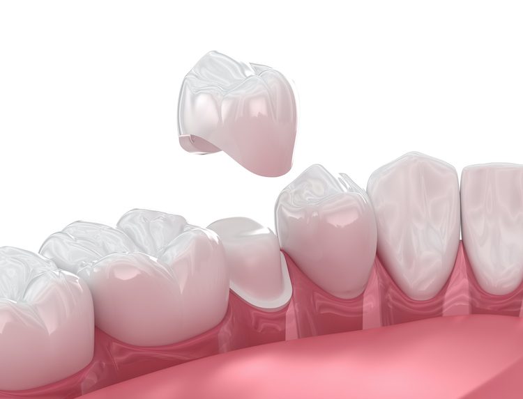 What to Expect When Getting a Dental Crown