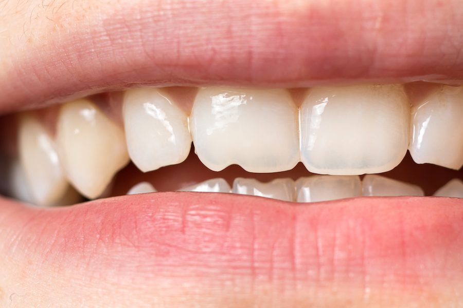 Fix chipped teeth with bonding or veneers