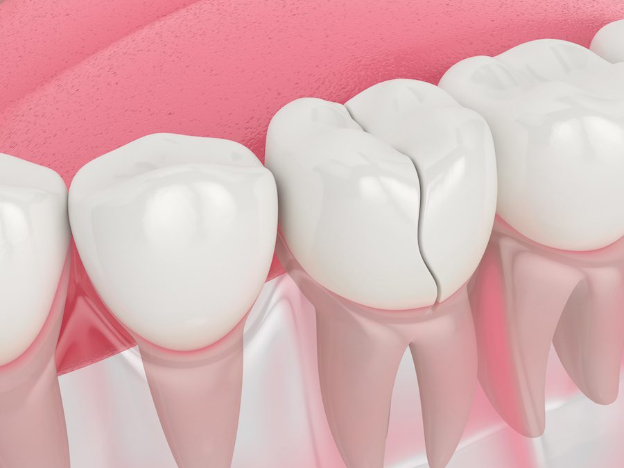 Cracked teeth repair in Lexington KY