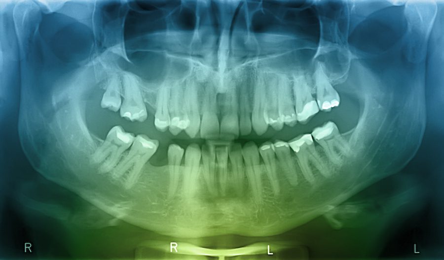 Missing teeth can cause shifting issues