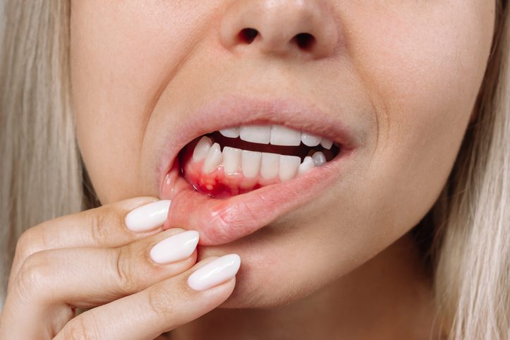 Treat bleeding gums before its too late