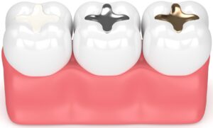 composite, gold, and amalgam dental fillings