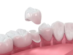 5 Things You Should Know About a Dental Crown in Lexington, KY