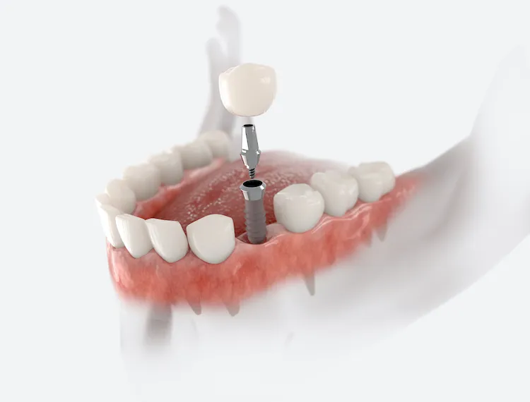 What Happens During a Dental Implant Procedure in Lexington, KY